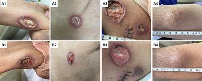 Disseminated Acanthamoeba castellanii infection in a patient with AIDS: a case report and literature review
